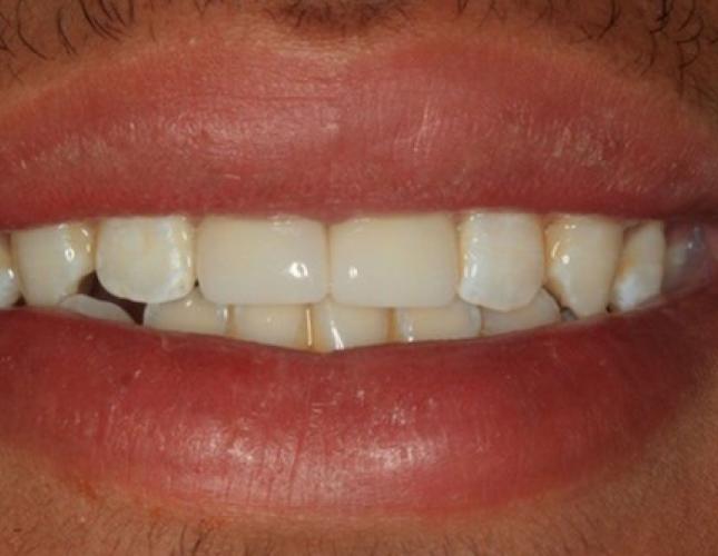 Veneers 6 after
