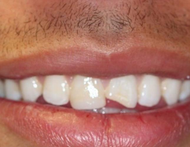 Veneers 6 before
