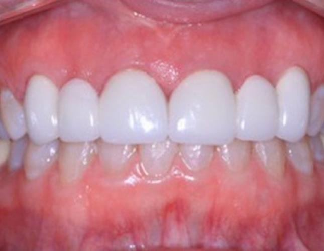 Crowns 4 after
