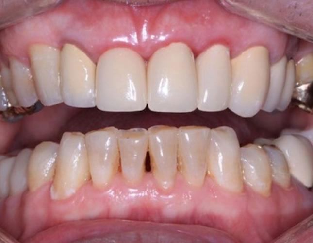 Crowns 6 after
