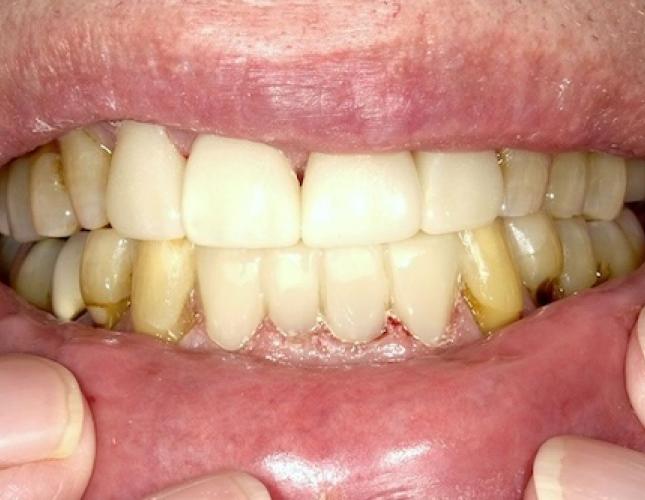 Crowns 7 after