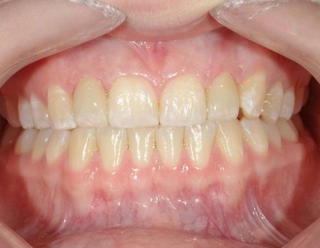 Crowns 9 after