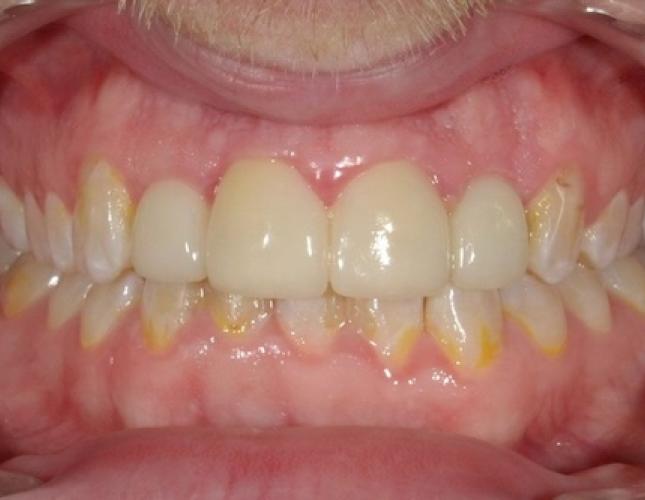 Crowns 10 after