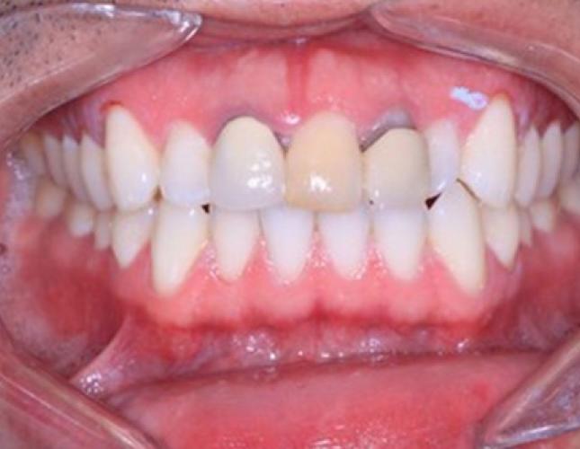 Crowns 5 before