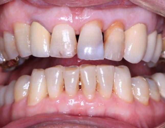 Crowns 6 before
