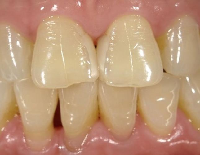 Crowns 8 before