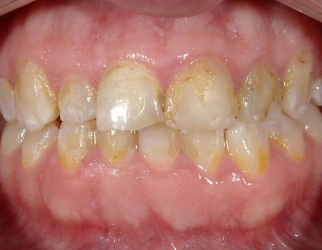 Crowns 10 before