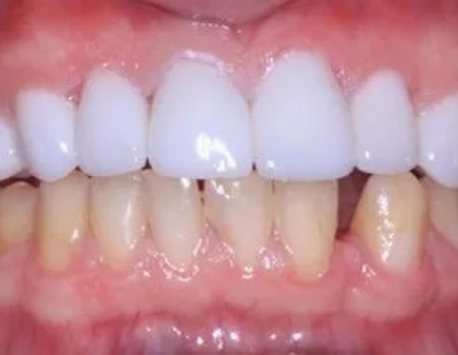 Crowns 1 after