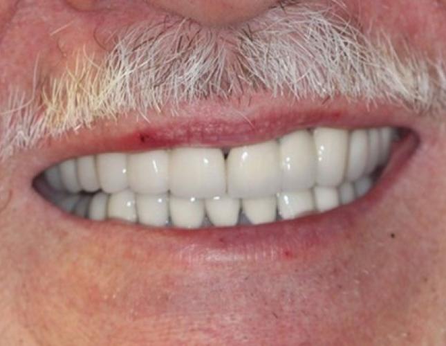 Full Mouth Reconstruction 4 after