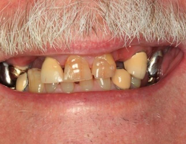 Full Mouth Reconstruction 4 before