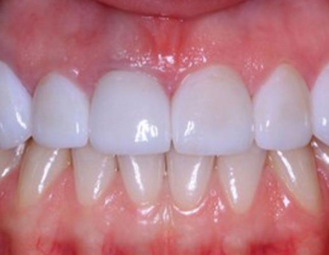 Veneers 5 after