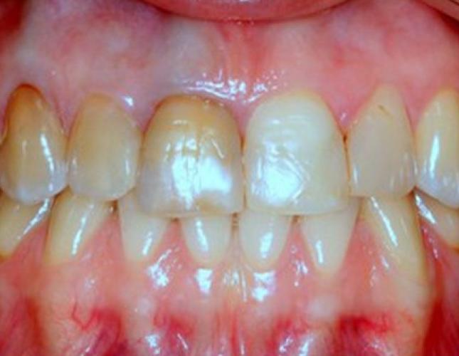 Veneers 5 before