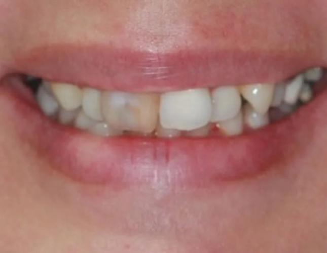 Full Mouth Reconstruction 2 before