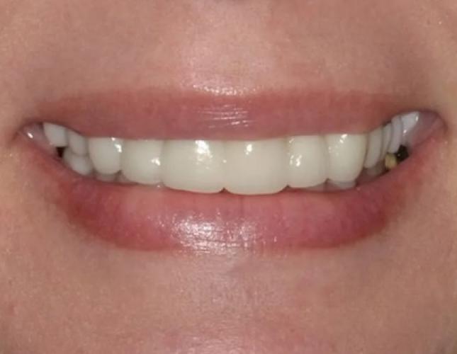 Full Mouth Reconstruction 2 after