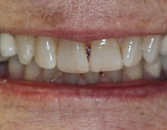 Full Mouth Reconstruction 3 before