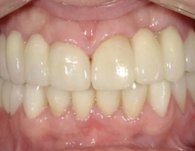 Full Mouth Reconstruction 1 after