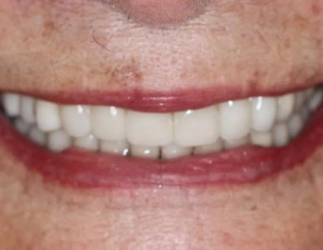 Full Mouth Reconstruction 3 after