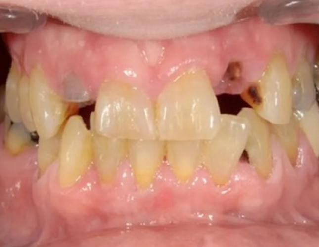 Full Mouth Reconstruction 1 before