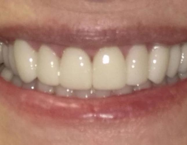 Veneers 1 after