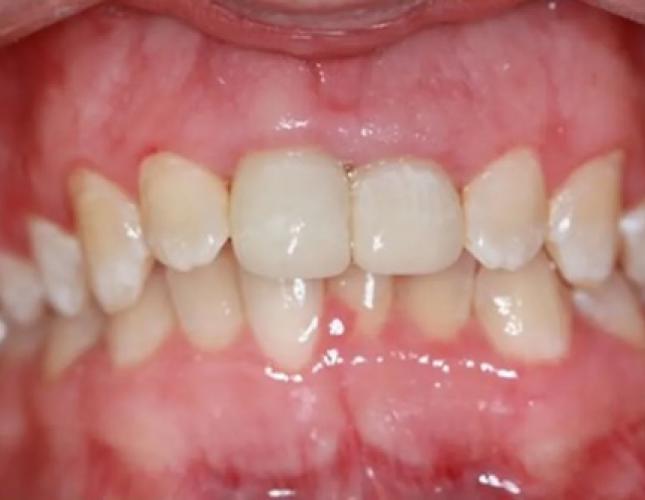 Veneers 3 after