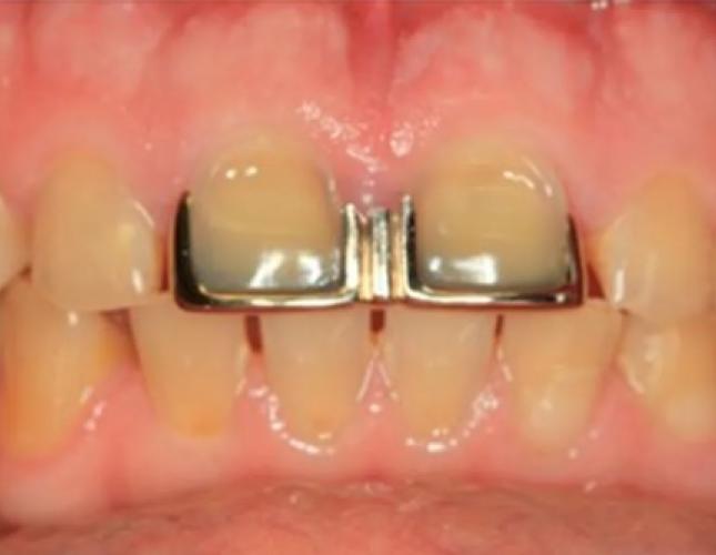 Veneers 2 before