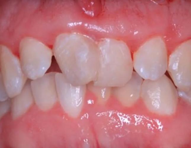 Veneers 3 before