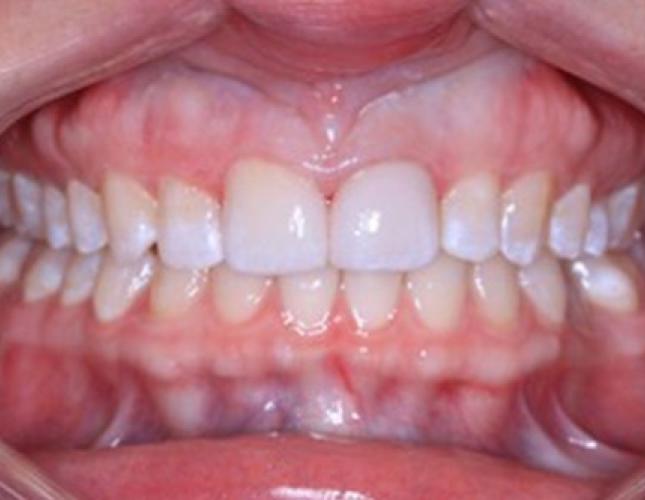 Veneers 4 after