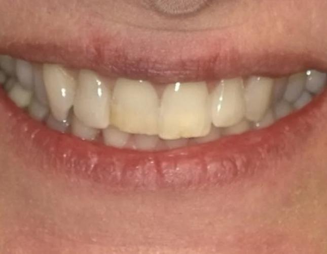 Veneers 1 before