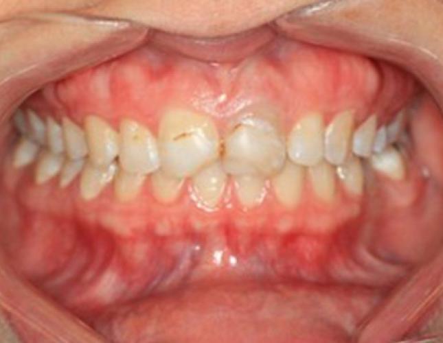 Veneers 4 before