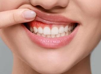 Genetic Factors in Periodontal Disease: Is Gum Health Hereditary?